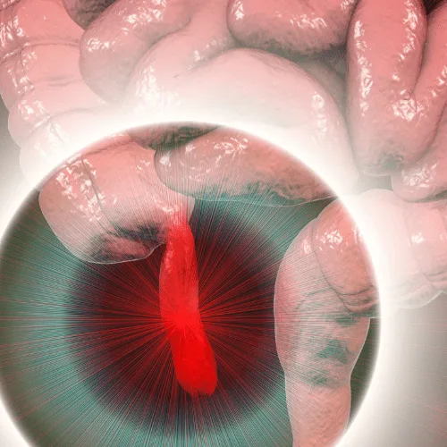 ¿Qué especialista trata los pólipos intestinales?