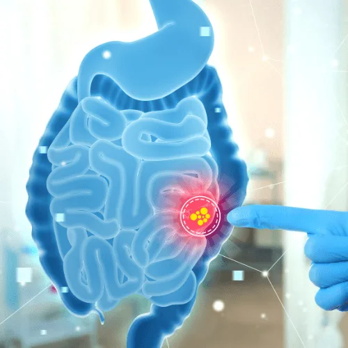 Reflujo gastroesofágico: Atención especializada en Guadalajara